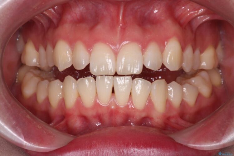 上下の前歯がぶつかって隙間が空いてしまう噛み合わせをなおす 治療前画像