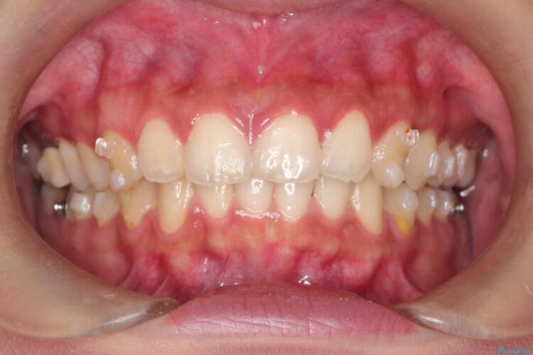ジェット水流＆微粒子パウダー(歯のクリーニング) 治療前画像