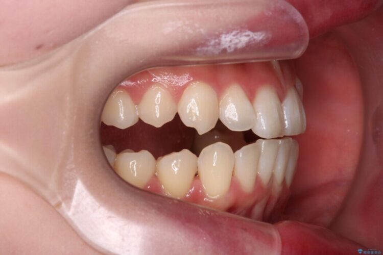 上下の前歯がぶつかって隙間が空いてしまう噛み合わせをなおす 治療前画像
