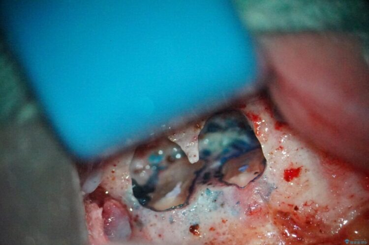 根尖性歯周炎の再発を歯根端切除術で治療する 治療前画像