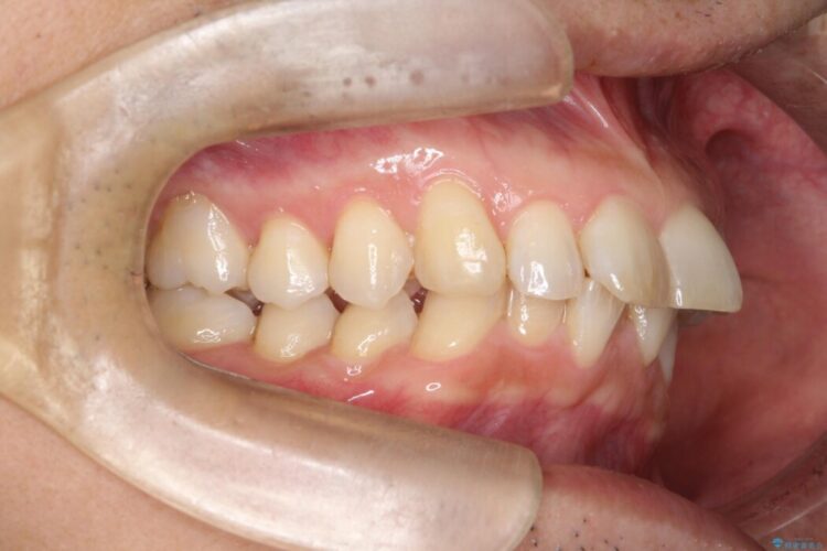 前歯のガタつきを改善したい 治療前画像