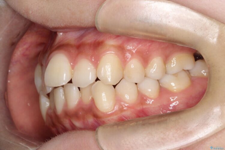 引っ込んだ前歯が目立つガタガタな歯列を抜歯矯正 治療前画像