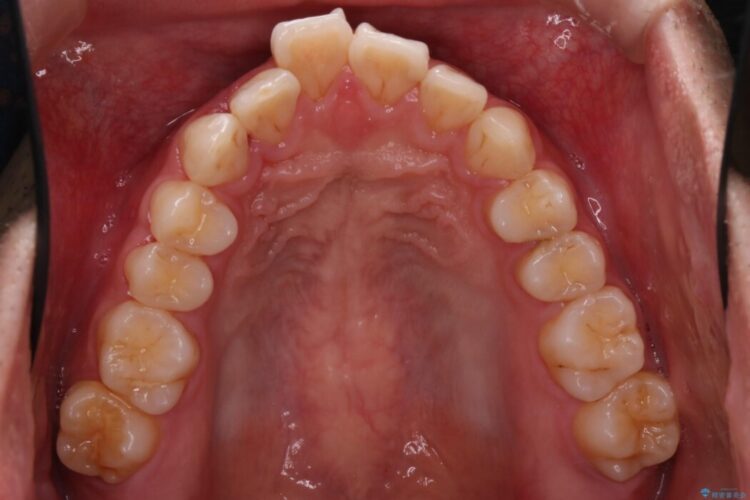 上顎前突（出っ歯）をインビザラインで矯正治療 治療前画像