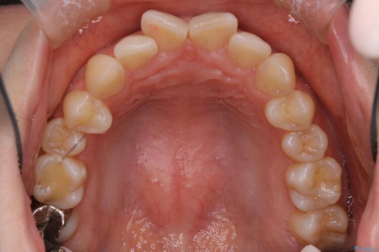 前歯の翼状捻転（ねじれ）をきれいな歯列へ 治療前画像