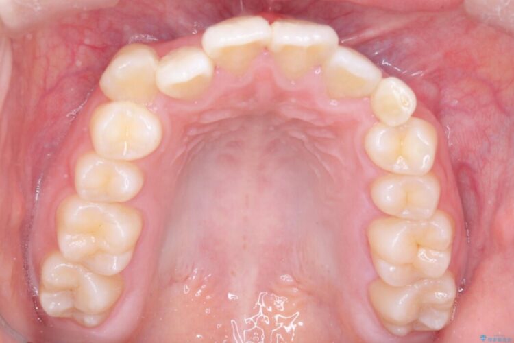 上顎埋伏犬歯の牽引による歯列矯正 治療前画像