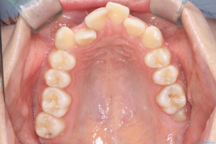 引っ込んだ前歯が目立つガタガタな歯列を抜歯矯正 治療前画像