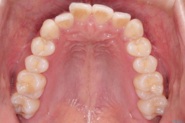 前歯のガタつき（叢生）をきれいに整える 治療前画像