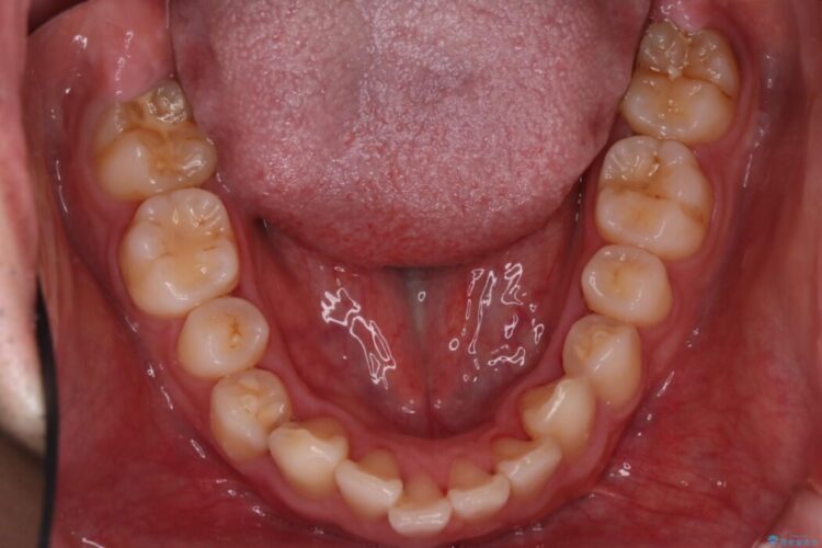 上顎前突（出っ歯）をインビザラインで矯正治療 治療前画像