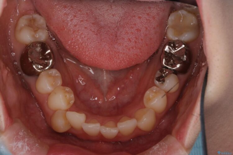 前歯の翼状捻転（ねじれ）をきれいな歯列へ 治療前画像