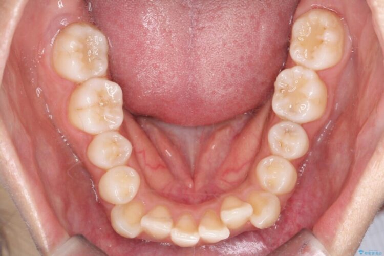 引っ込んだ前歯が目立つガタガタな歯列を抜歯矯正 治療前画像
