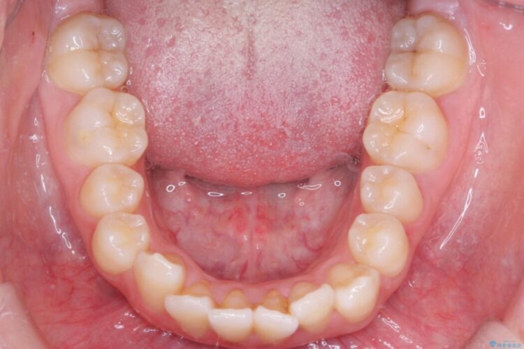 上顎埋伏犬歯の牽引による歯列矯正 治療前画像