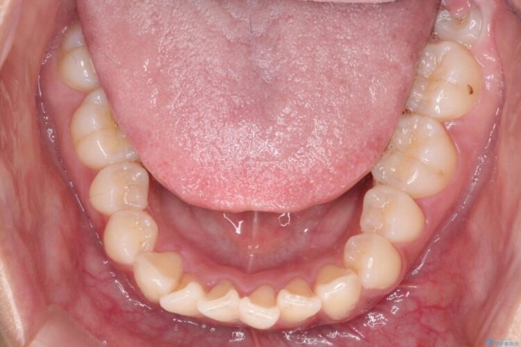 前歯のガタつき（叢生）をきれいに整える 治療前画像