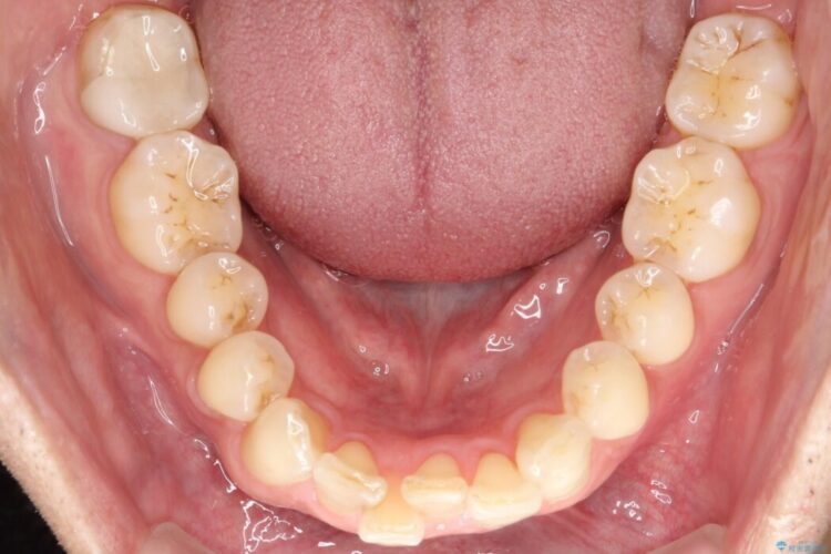 前歯のガタつきを改善したい 治療前画像