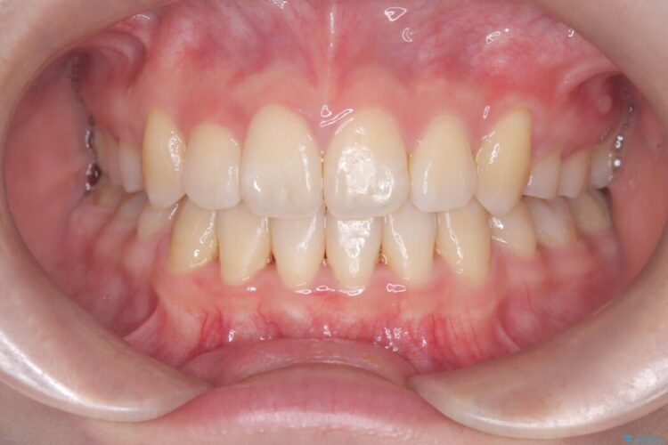 上顎埋伏犬歯の牽引による歯列矯正 治療後画像