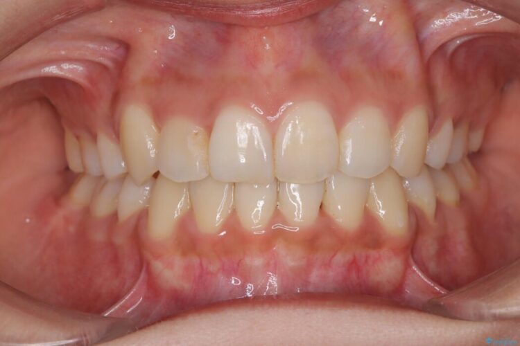 引っ込んだ前歯が目立つガタガタな歯列を抜歯矯正 アフター