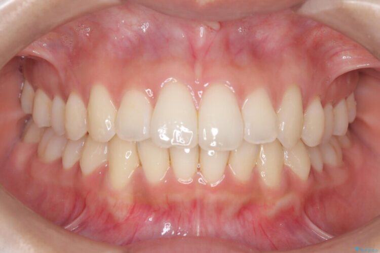 前歯のガタつき（叢生）をきれいに整える 治療後画像