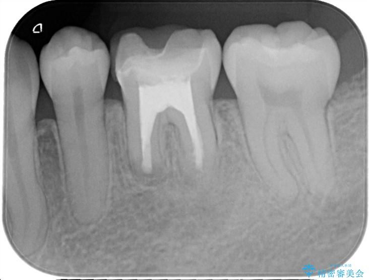 根尖性歯周炎の再発を歯根端切除術で治療する アフター