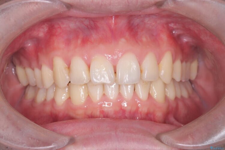 上顎前突（出っ歯）をインビザラインで矯正治療 治療後画像