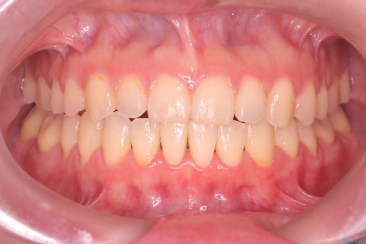 上下の前歯がぶつかって隙間が空いてしまう噛み合わせをなおす 治療後画像