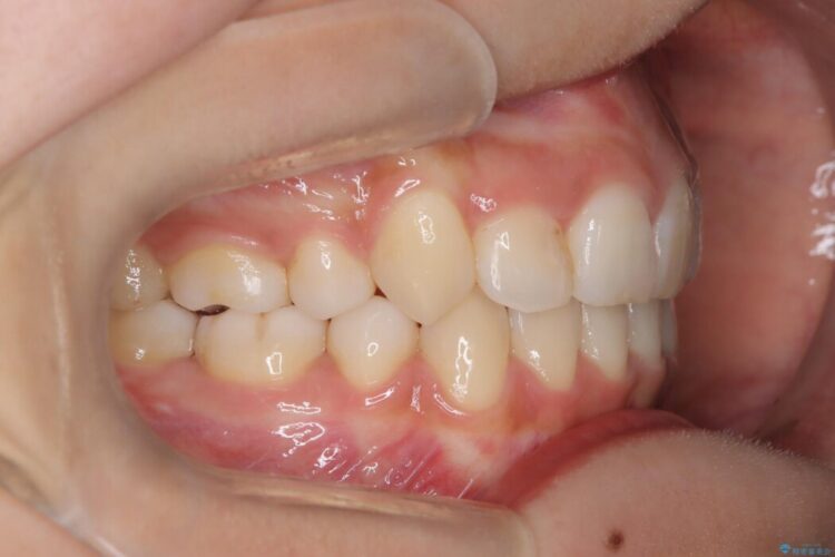 引っ込んだ前歯が目立つガタガタな歯列を抜歯矯正 治療後画像