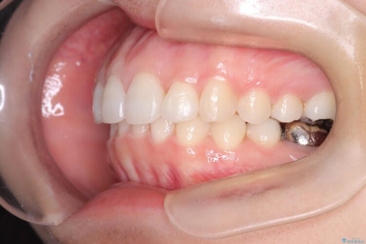 飛び出た前歯の形を変えたい 治療後画像