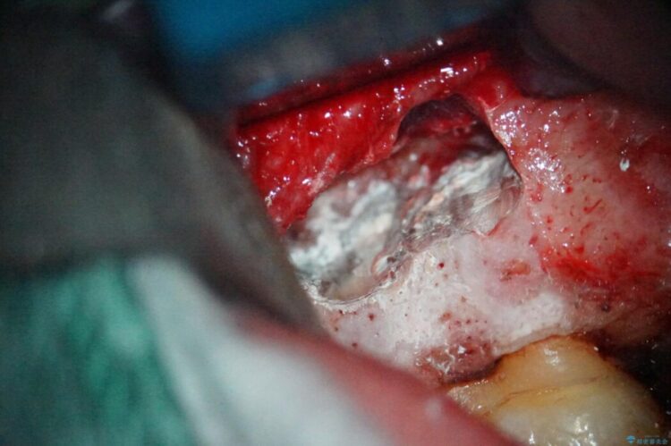 根尖性歯周炎の再発を歯根端切除術で治療する 治療後画像