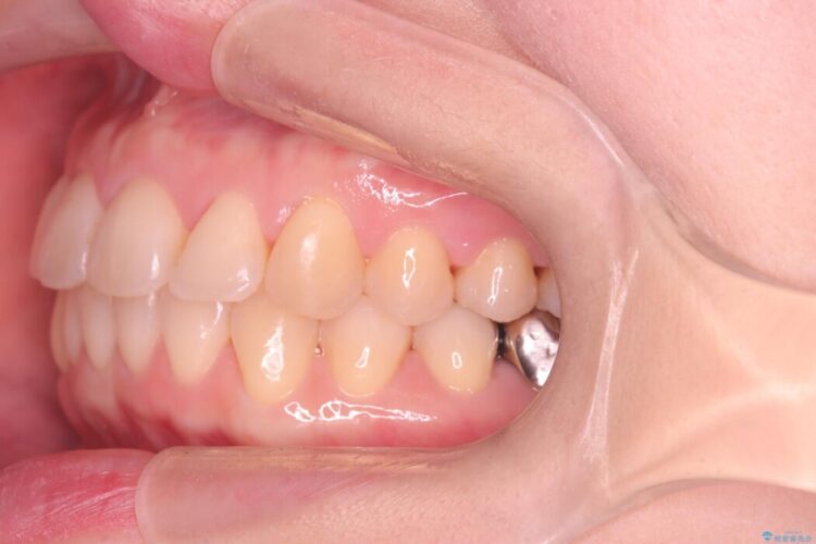 前歯の翼状捻転（ねじれ）をきれいな歯列へ 治療後画像