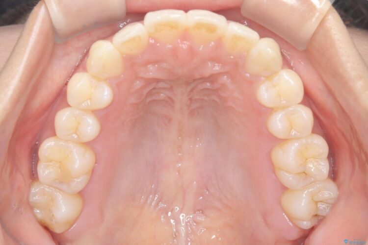 前歯のガタつき（叢生）をきれいに整える 治療後画像