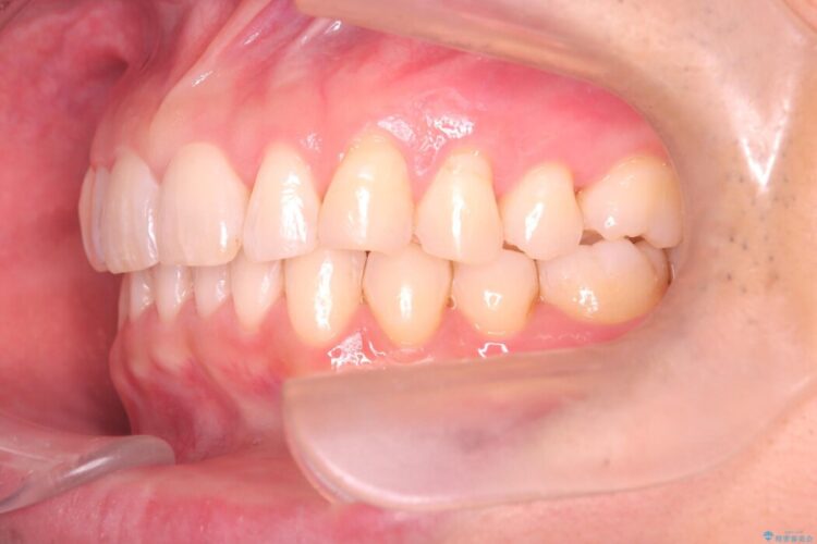 前歯のガタつきを改善したい 治療後画像