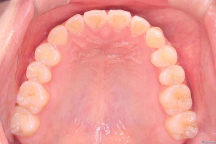 上下の前歯がぶつかって隙間が空いてしまう噛み合わせをなおす 治療後画像