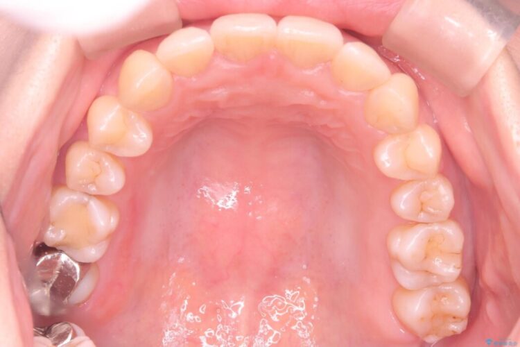 前歯の翼状捻転（ねじれ）をきれいな歯列へ 治療後画像