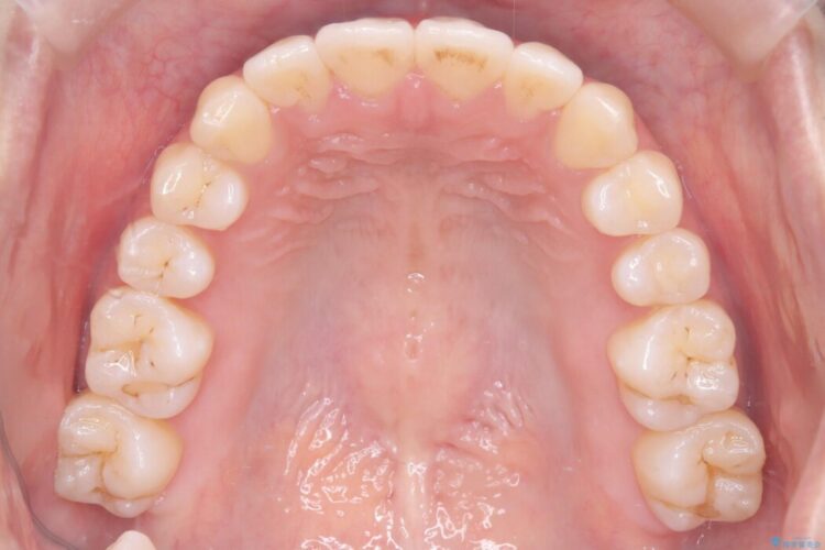 軽度のガタつきを納得のいく歯列へワイヤー矯正 治療後画像