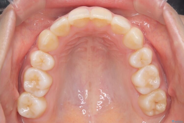 引っ込んだ前歯が目立つガタガタな歯列を抜歯矯正 治療後画像