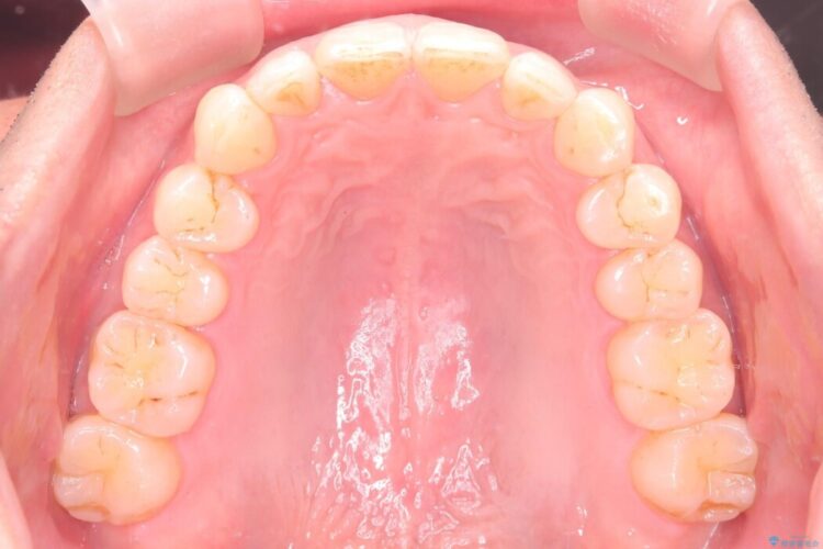 前歯のガタつきを改善したい 治療後画像