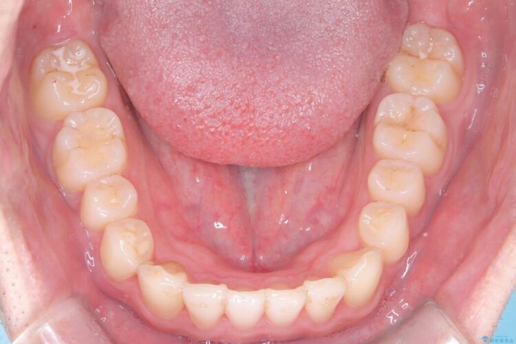 上顎前突（出っ歯）をインビザラインで矯正治療 治療後画像
