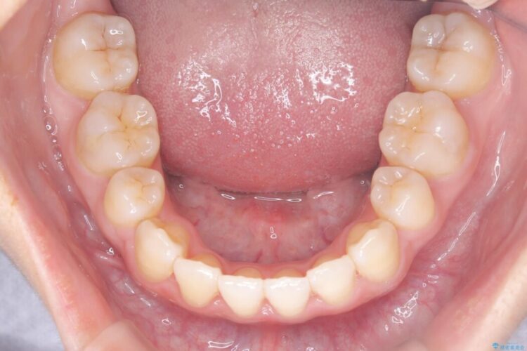 上顎埋伏犬歯の牽引による歯列矯正 治療後画像