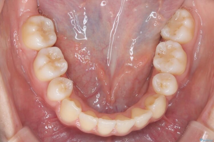 引っ込んだ前歯が目立つガタガタな歯列を抜歯矯正 治療後画像