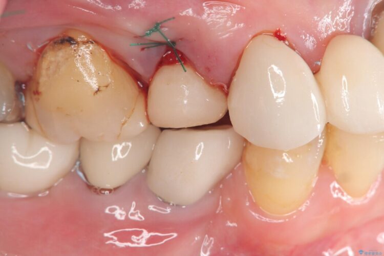 歯根破折による抜歯即時インプラント（1DAYインプラント） 治療途中画像