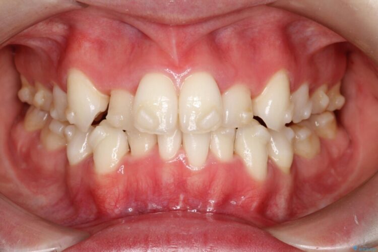 インビザラインでの抜歯矯正治療 治療途中画像