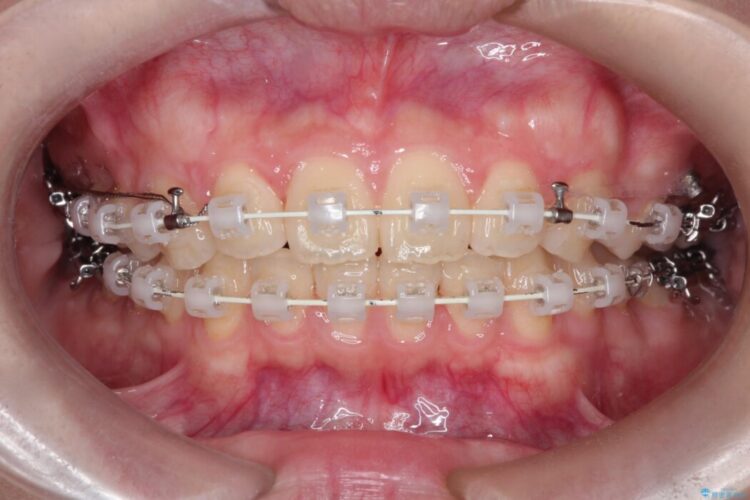 前歯の正中線のズレをなおす 治療途中画像