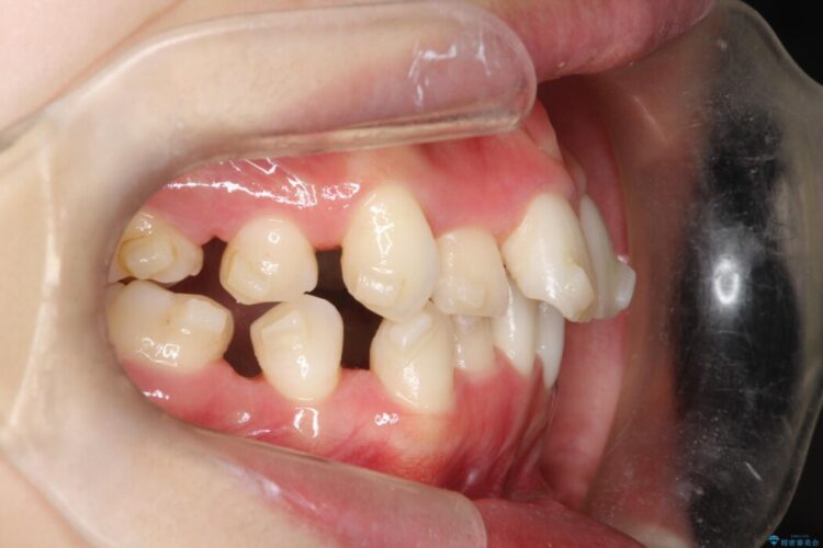インビザラインでの抜歯矯正治療 治療途中画像