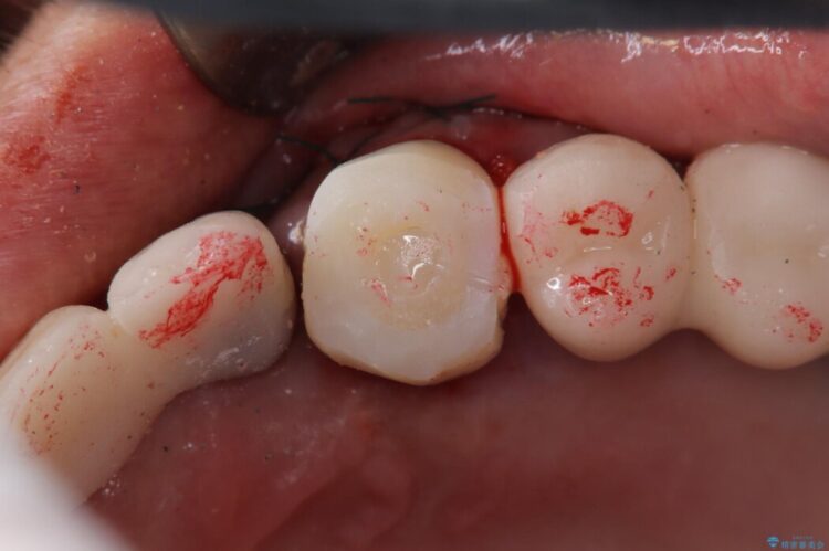 【1Dayインプラント】抜歯の即日にインプラントを埋入する 治療途中画像