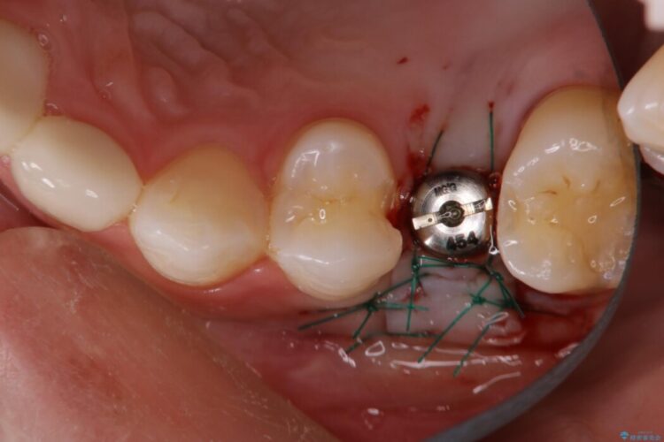 【1Dayインプラント】歯科医院へ通う回数を少なくしたい 治療途中画像