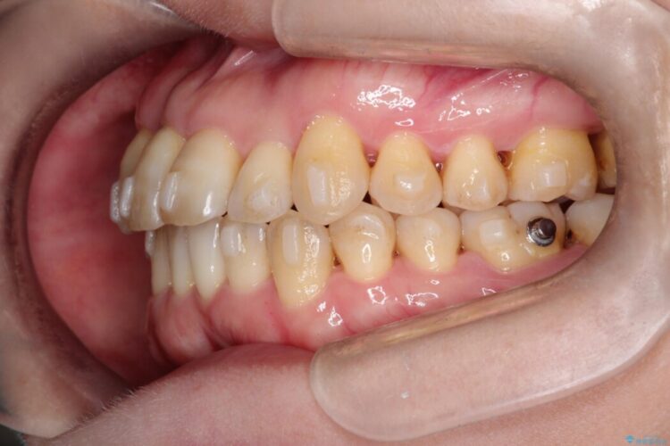 前歯のかみ合わせを改善したい 治療途中画像