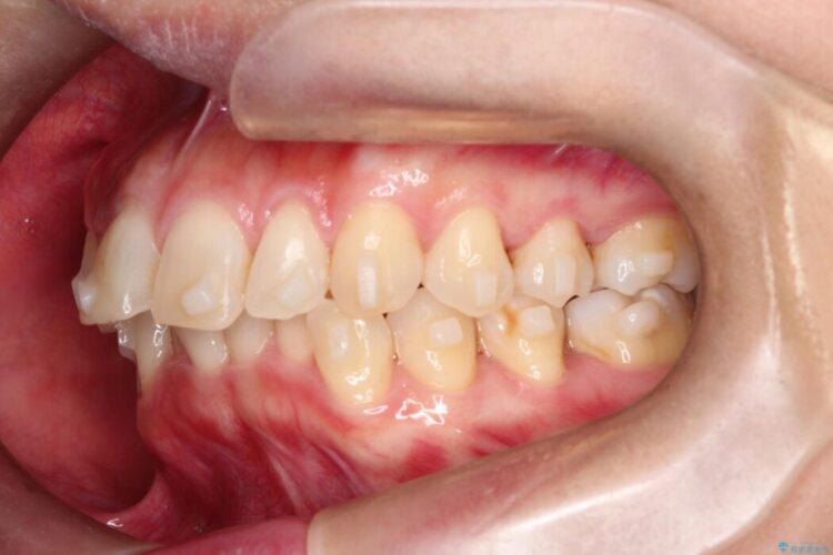 【インビザライン】ガタガタな前歯を整える 治療途中画像