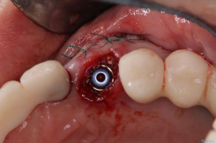 【1Dayインプラント】抜歯の即日にインプラントを埋入する 治療途中画像