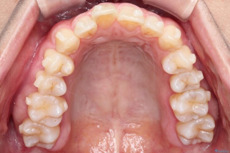 【インビザライン】ガタガタな前歯を整える 治療途中画像