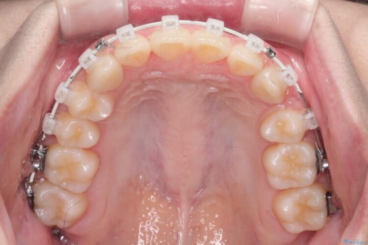 前歯の正中線のズレをなおす 治療途中画像
