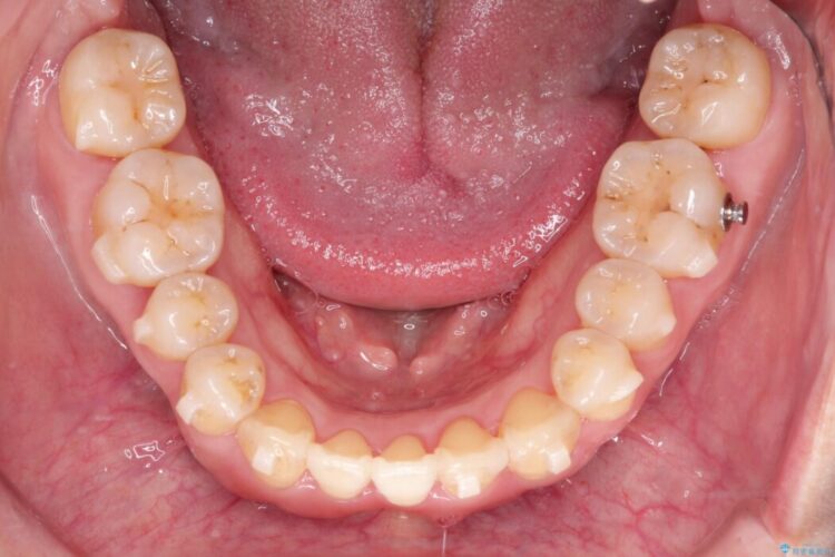 前歯のかみ合わせを改善したい 治療途中画像
