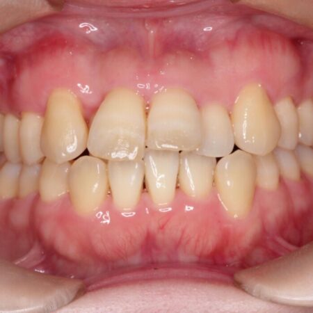 前歯のかみ合わせを改善したい 治療前
